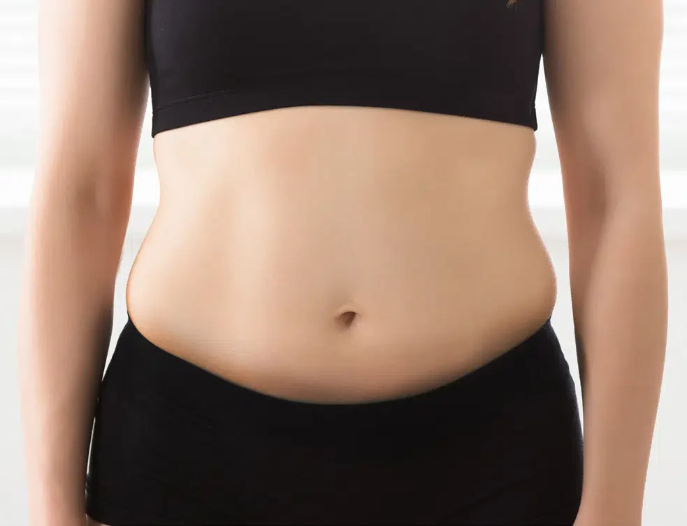 BodyTone female patient before treatment