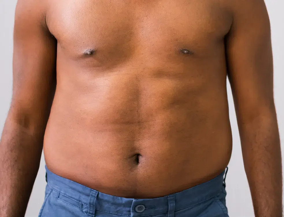 BodyTone male patient before treatment