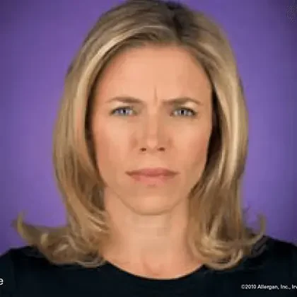 Botox patient before treatment
