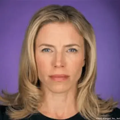 Botox patient 14 days after treatment