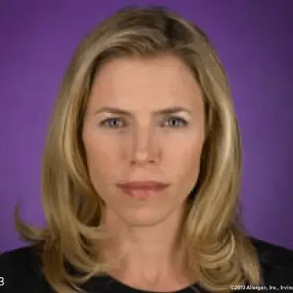 Botox patient three months after treatment
