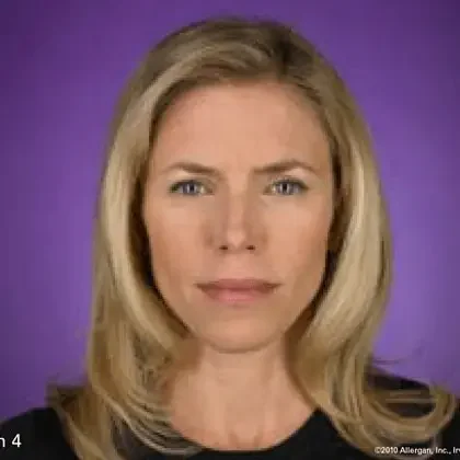 Botox patient four months after treatment