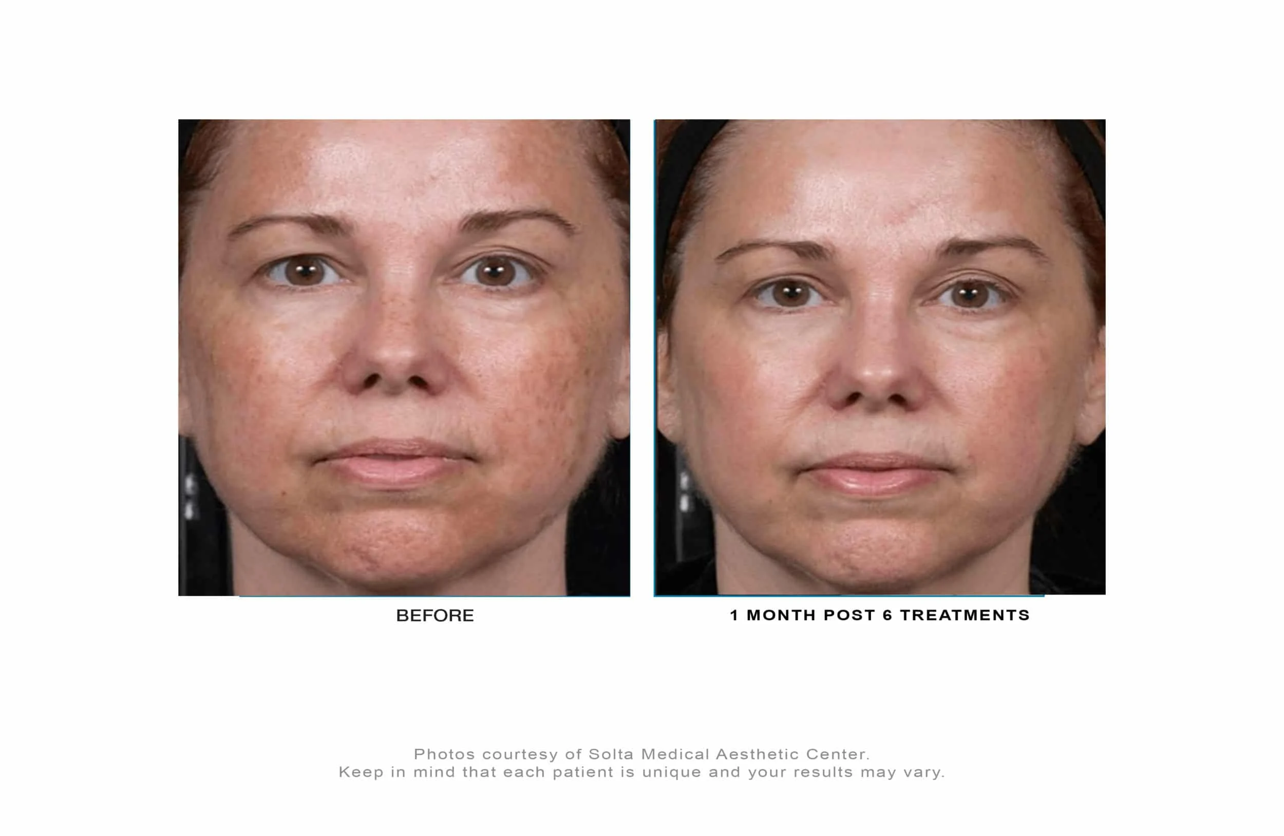 Clear + Brilliant before-and-after result 1