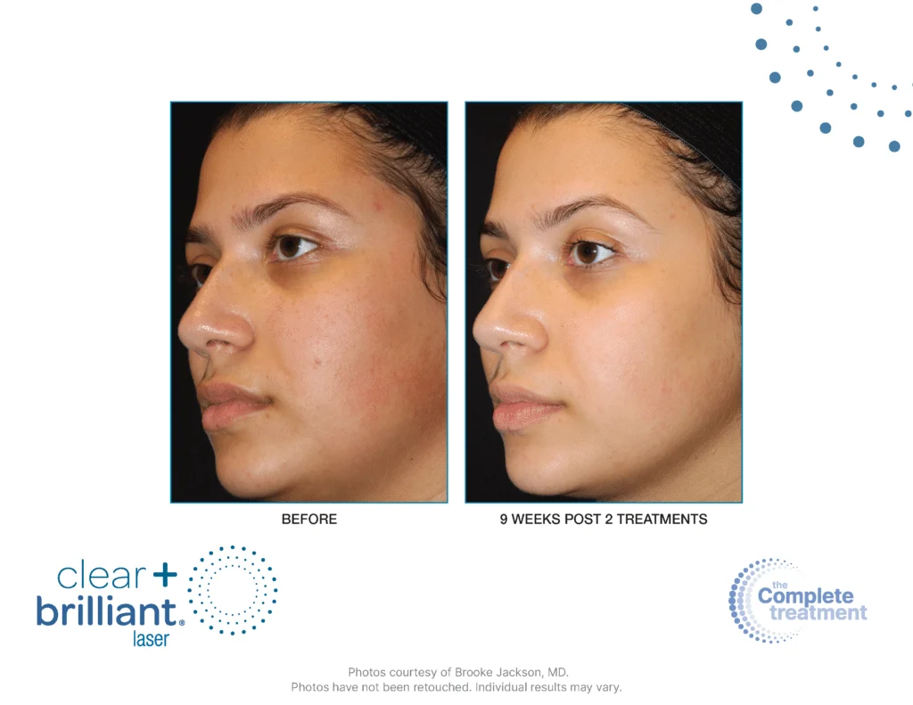 Clear + Brilliant before-and-after result 2