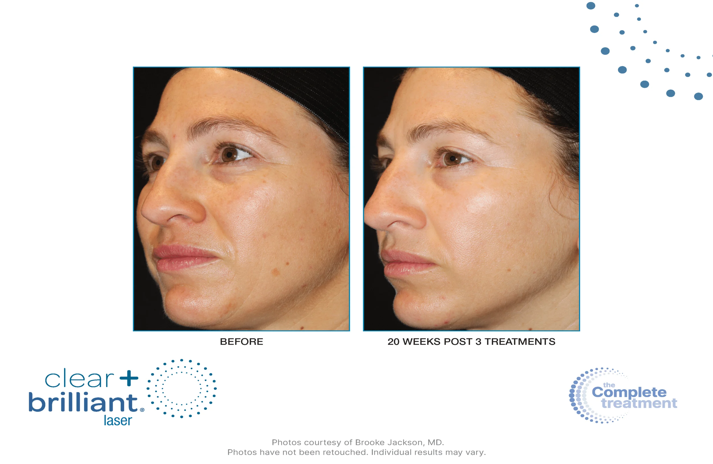 Clear + Brilliant before-and-after result 3