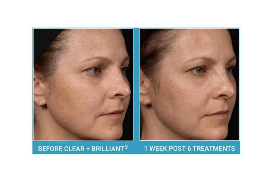 Clear + Brilliant before-and-after result 4