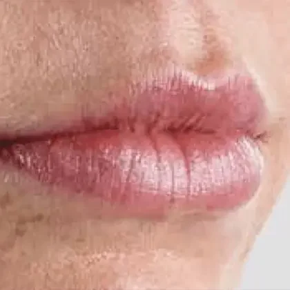 Dermal filler patient after treatment, side view