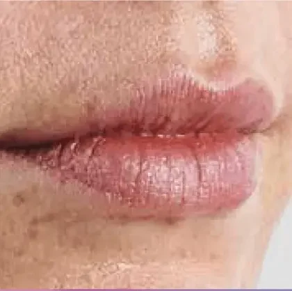 Dermal filler patient before treatment, side view