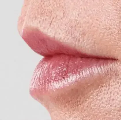 Dermal filler patient after treatment, result 2