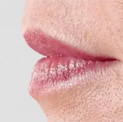 Dermal filler patient before treatment, result 2