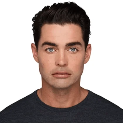 Male Juvéderm patient after treatment, result 2