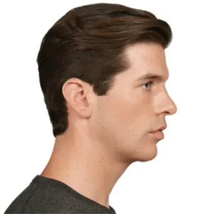 Male chin-filler patient after treatment