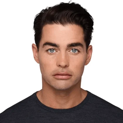 Male Juvéderm patient before treatment, result 2