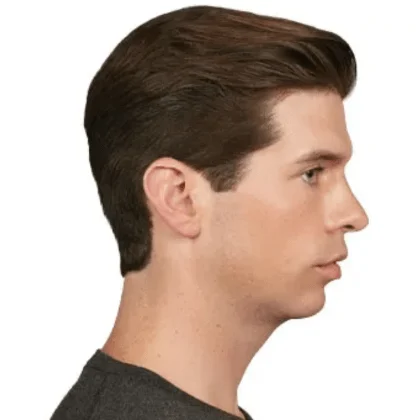 Male chin-filler patient before treatment