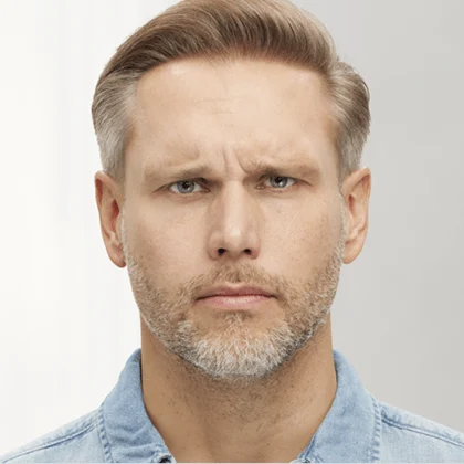 Male Botox patient after treatment, result 2