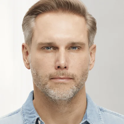 Male Botox patient before treatment, result 2