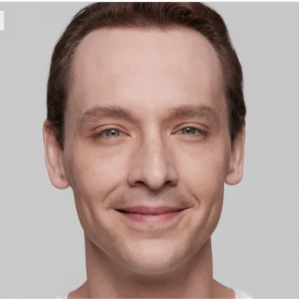 Male Restylane patient before treatment, result 2