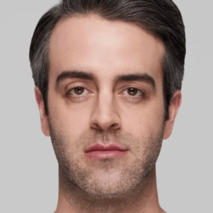 Male Restylane patient before treatment, result 1