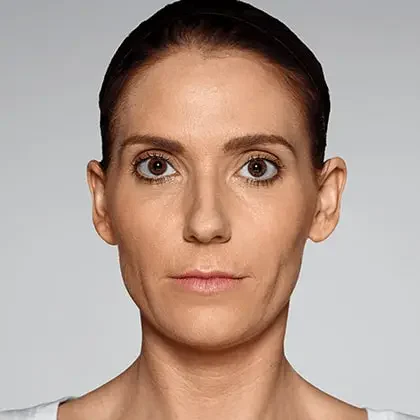 Restylane patient after treatment, result 1