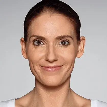 Restylane patient after treatment, result 2