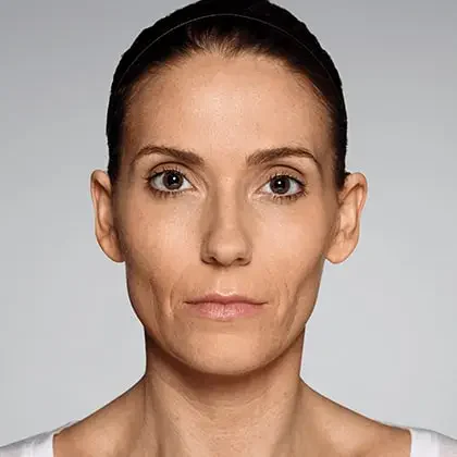 Restylane patient before treatment, result 1