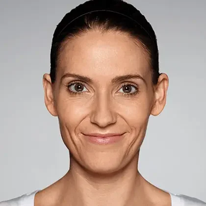 Restylane patient before treatment, result 2