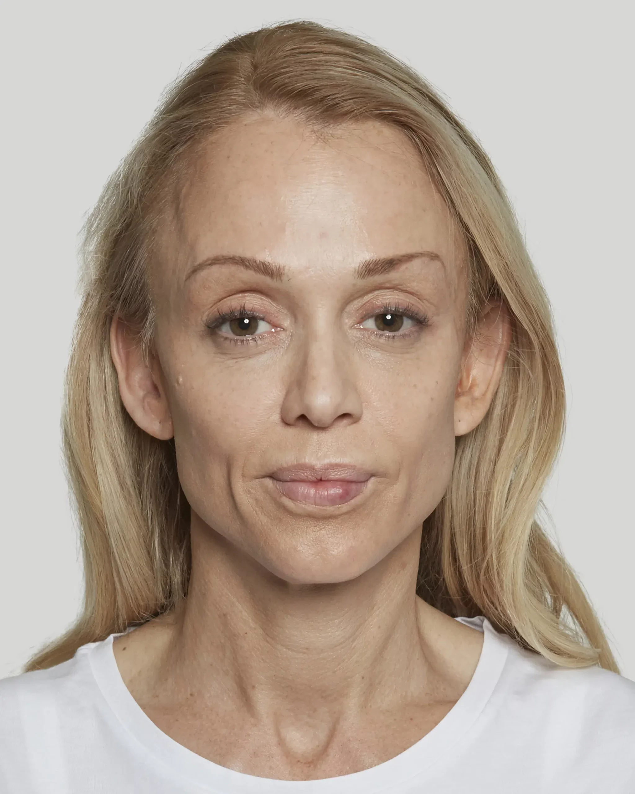 Sculptra patient 15 weeks after treatment, front view