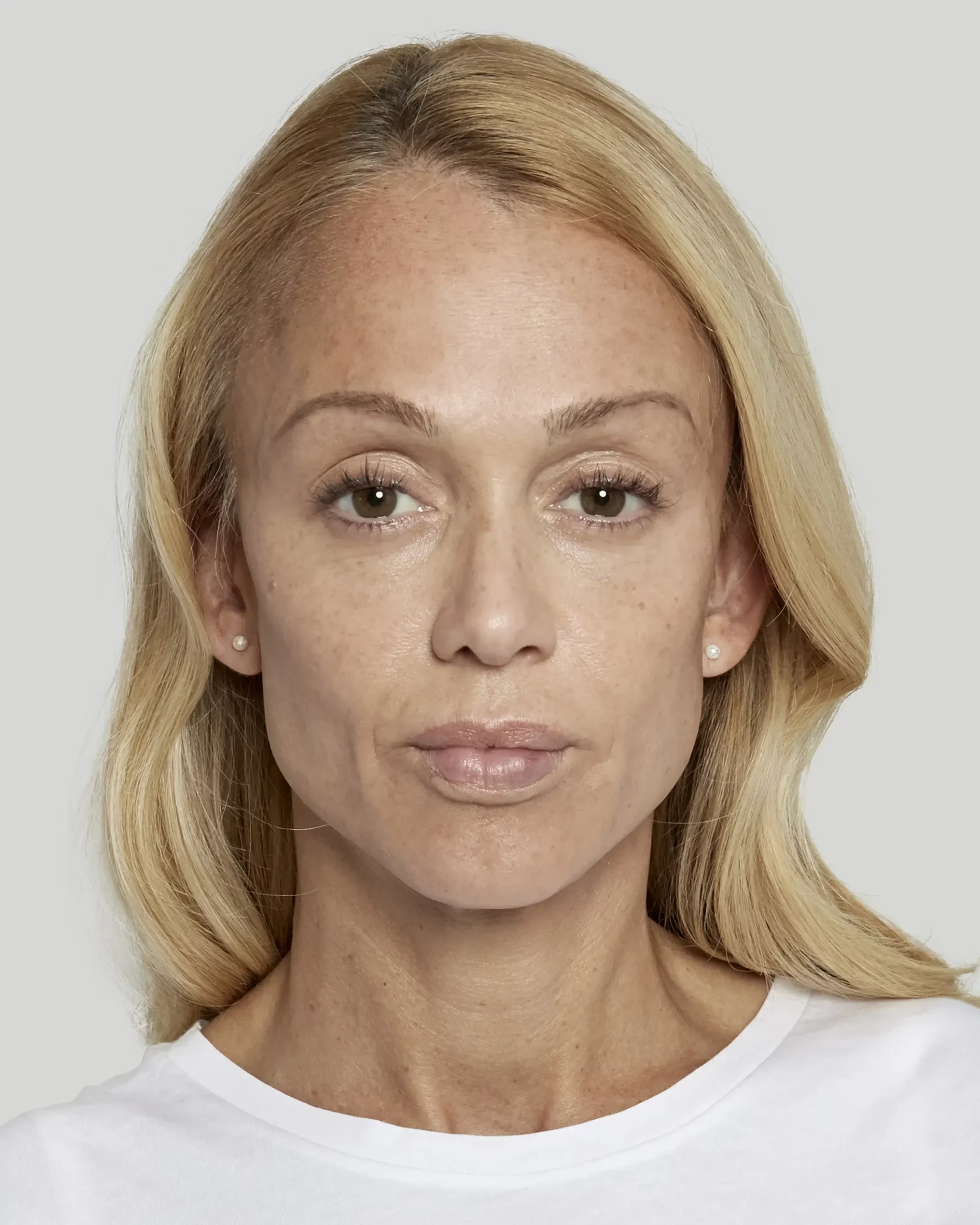 Sculptra patient 24 weeks after treatment, front view