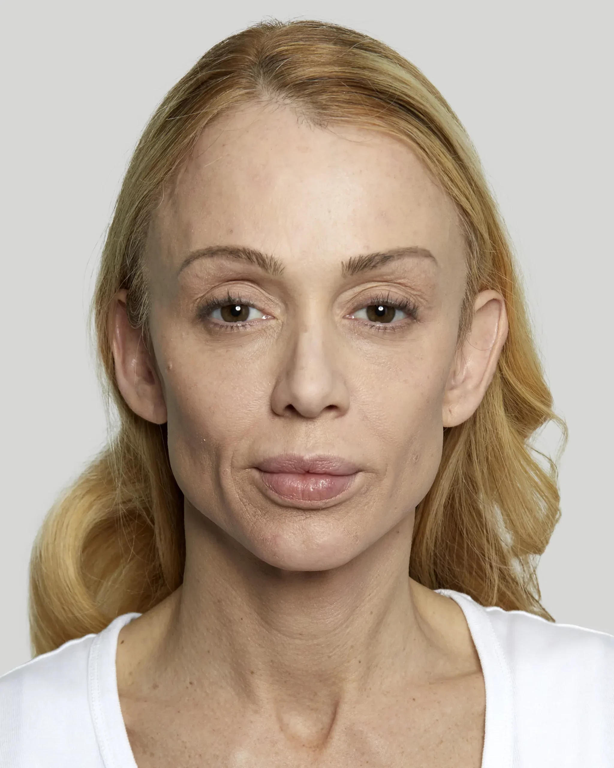 Sculptra patient before treatment, front view
