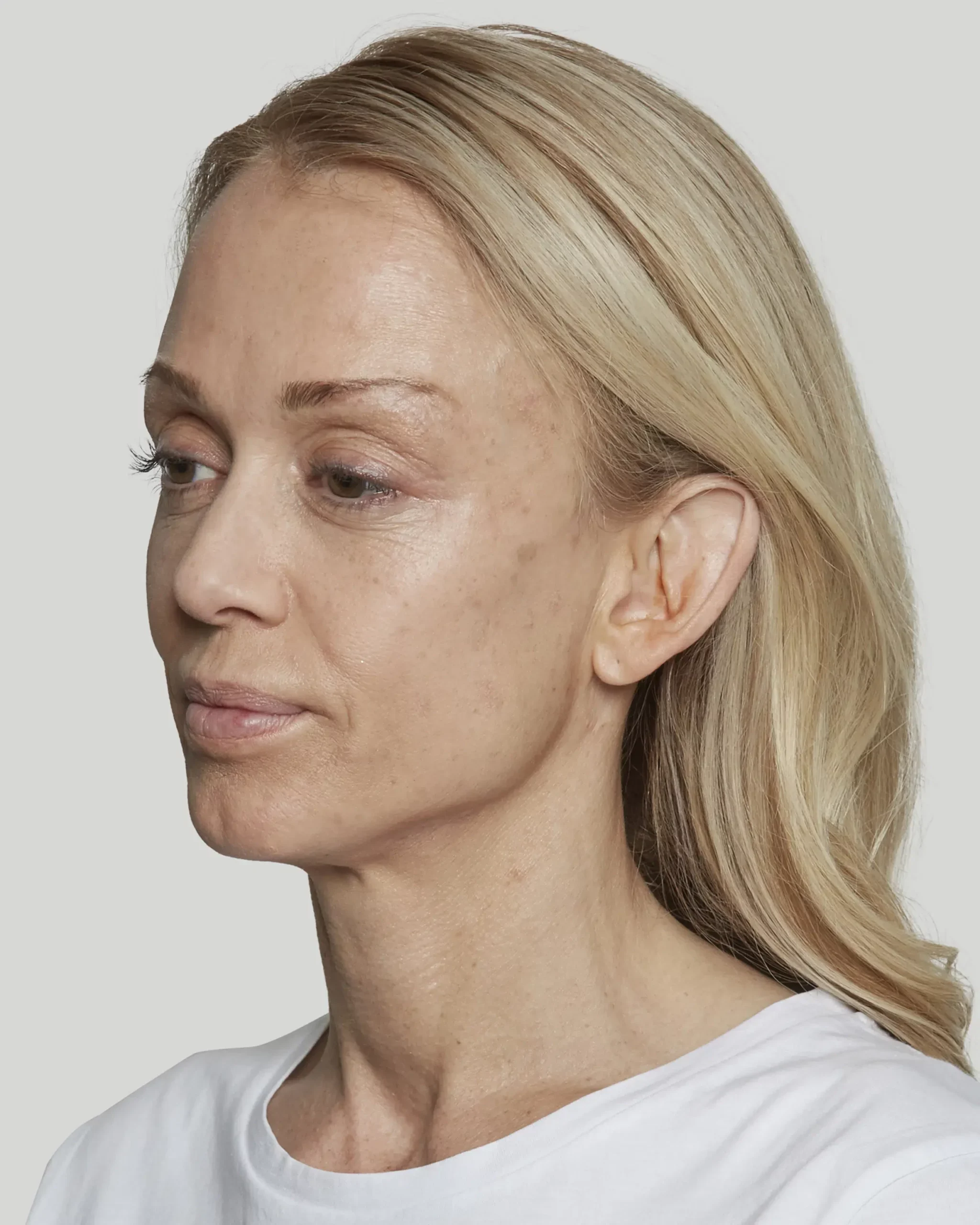 Sculptra patient 15 weeks after treatment, left profile