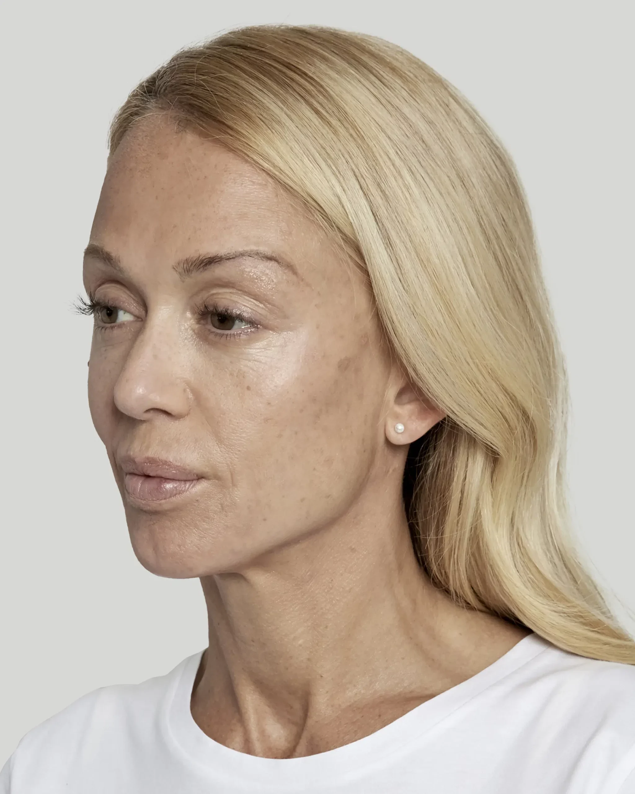 Sculptra patient 24 weeks after treatment, left profile