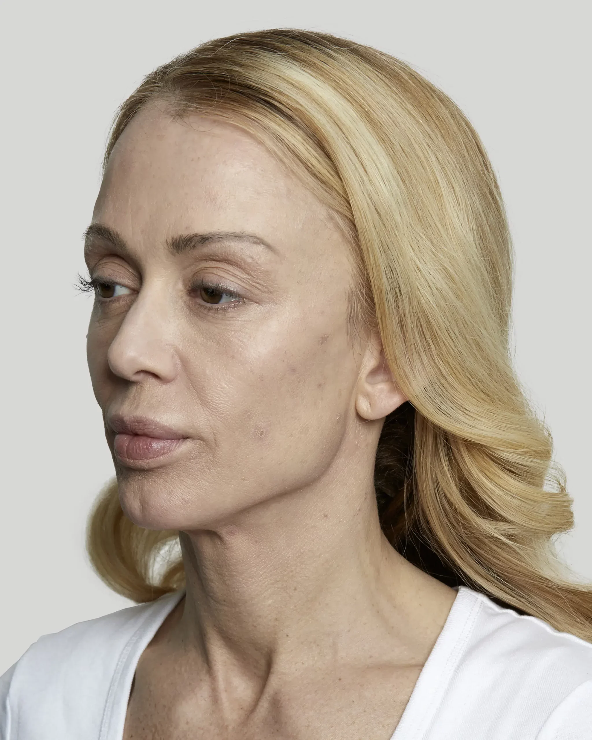Sculptra patient before treatment, left profile