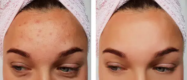 Acne treatment before and after comparison