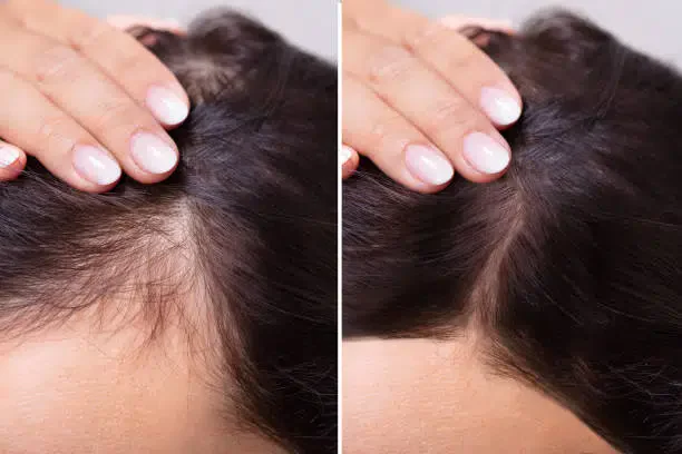 Hair-loss consultation and treatment planning