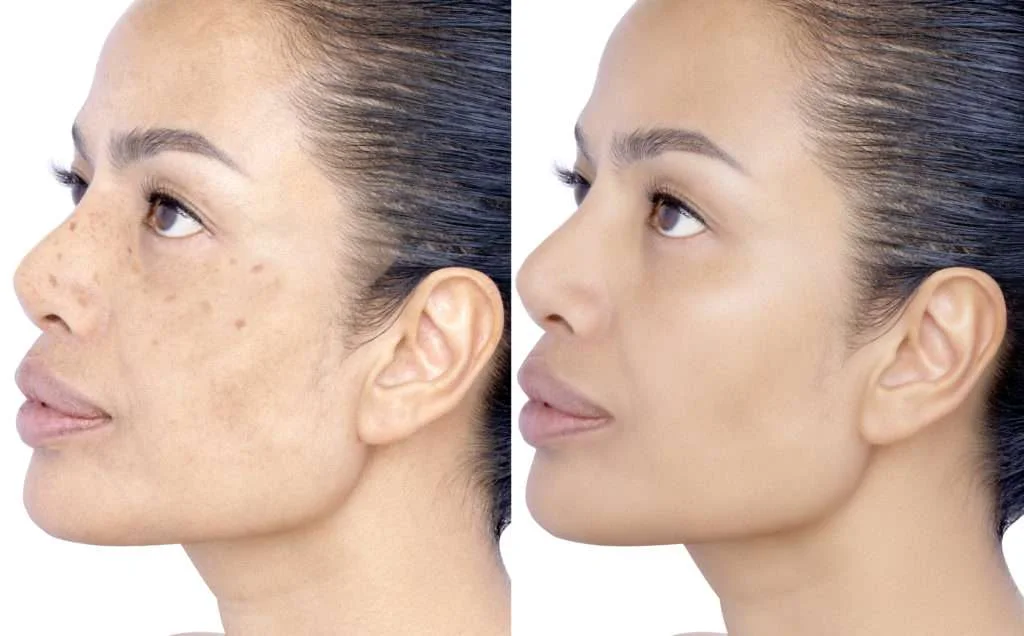 Woman representing melasma treatment